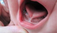Apa Itu Tongue Tie Pada Si Kecil? Kenali Ciri, Dampak, Penyembuhnya