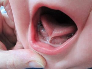 Apa Itu Tongue Tie Pada Si Kecil? Kenali Ciri, Dampak, Penyembuhnya