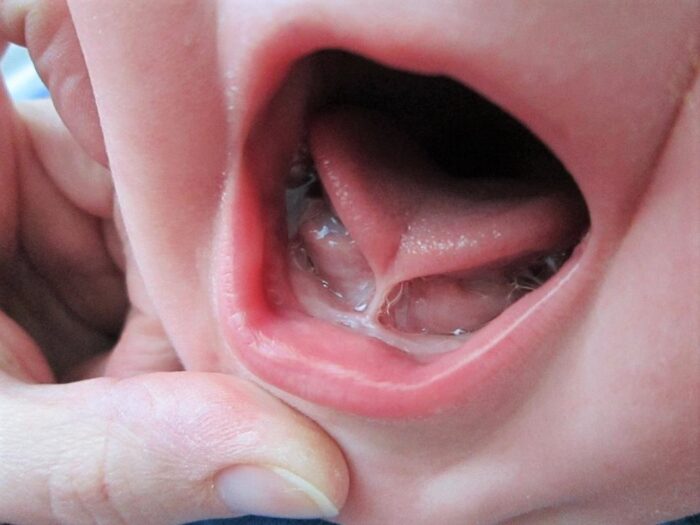 Apa Itu Tongue Tie Pada Si Kecil? Kenali Ciri, Dampak, Penyembuhnya