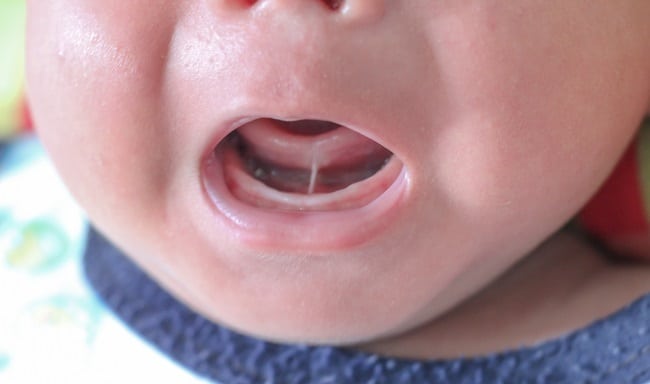 Apa Pengertian Tongue Tie